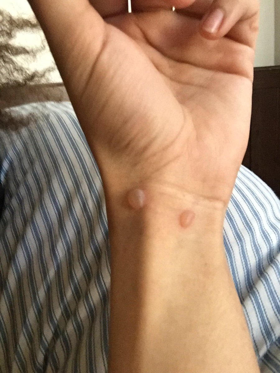 cigarette put out on your skin Someone to someone else: Hey you won't put a cigarette  out on your skin *me taking it as an indirect challenge*: