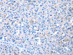 The image on the left is immunohistochemistry of paraffin-embedded Human liver cancer tissue using the antibody Antibody) at dilution 1/20, on the right is treated with synthetic peptide. (Original magnification: ×200)