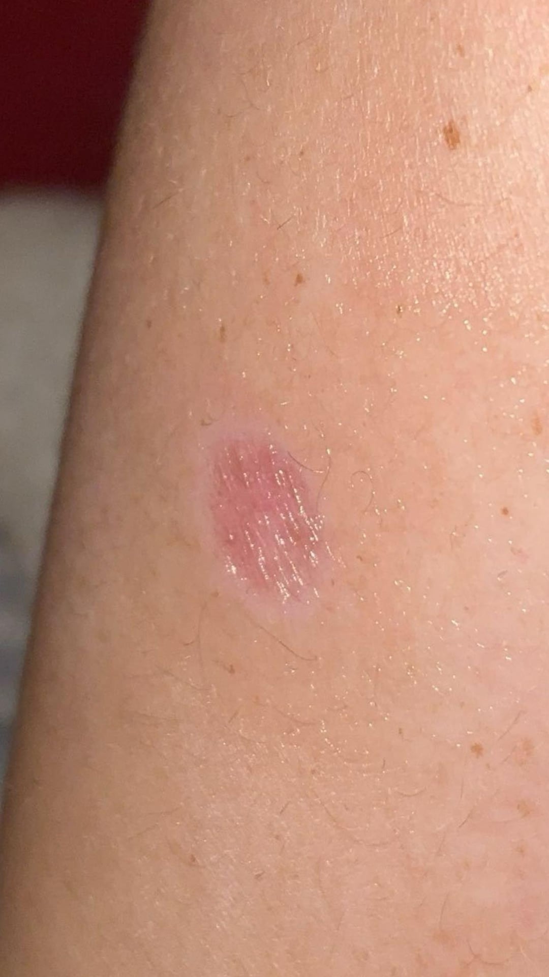 Cigarette burn scar : r/Skincare_Addiction